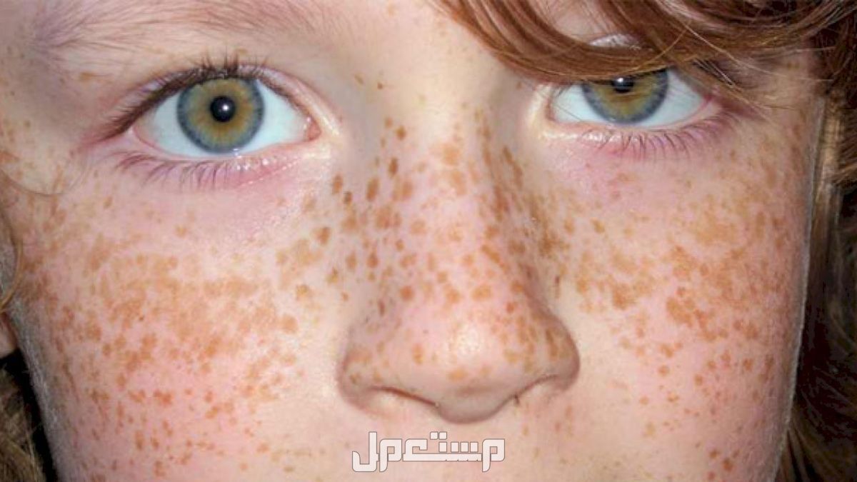 أسباب ظهور النمش المفاجئ طرق علاج النمش المفاجيء