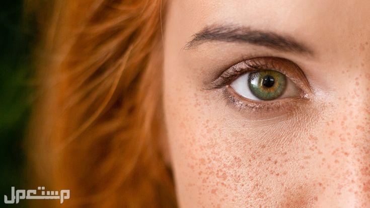أسباب ظهور النمش المفاجئ ظهور النمش في الوجه بشكل مفاجيء