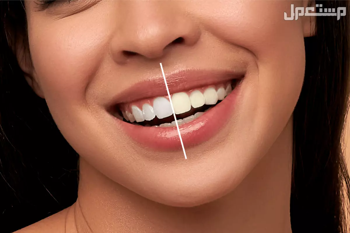 أفضل 10 خلطات طبيعية لتبييض الأسنان بالصور خلطات تبيض الأسنان في 5 دقائق