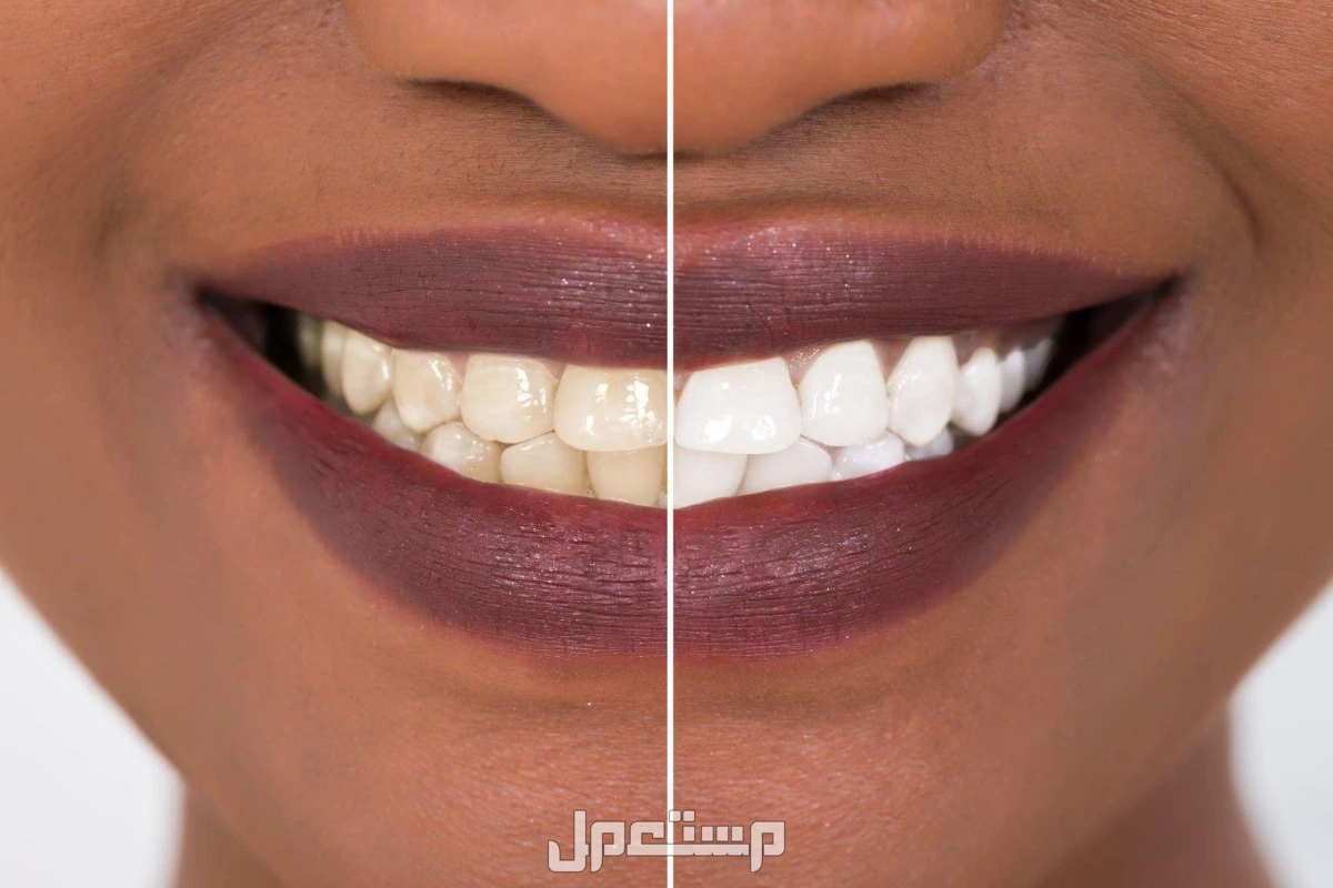 أفضل 10 خلطات طبيعية لتبييض الأسنان بالصور تبييض الأسنان بالكركم