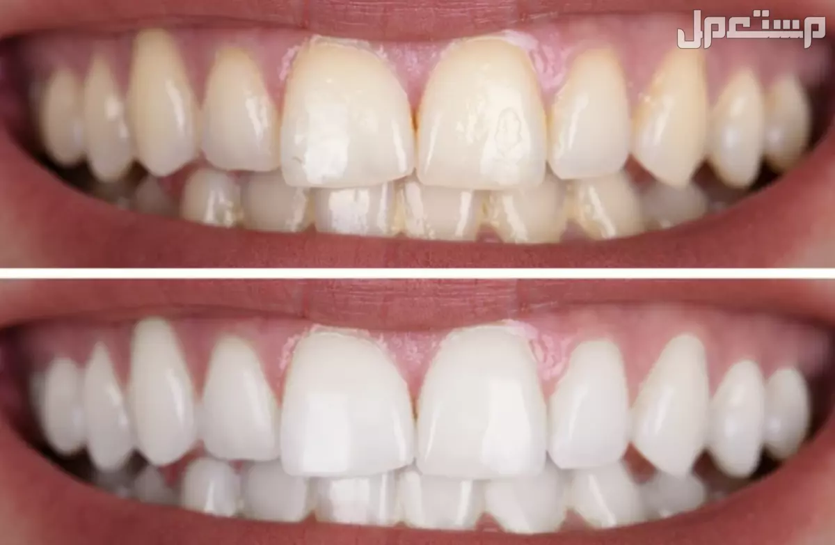 أفضل 10 خلطات طبيعية لتبييض الأسنان بالصور تبييض الأسنان بالملح