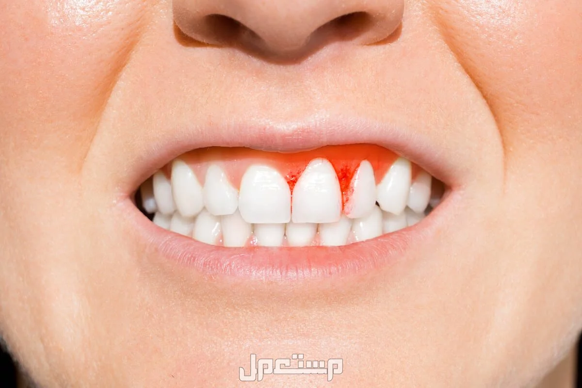 أفضل مضمضة لالتهاب اللثة وطرق العلاج من المنزل علامات التهاب اللثة