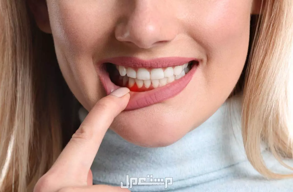أفضل مضمضة لالتهاب اللثة وطرق العلاج من المنزل التهاب اللثة