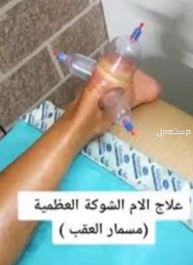 حجامه علاجيه و مساج تدليك منزلي حجامة الكعب و علاج آلام الكعب