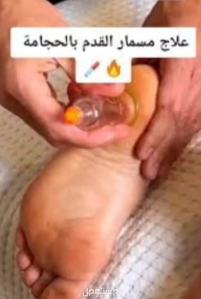 حجامه علاجيه و مساج تدليك منزلي حجامة الرجل