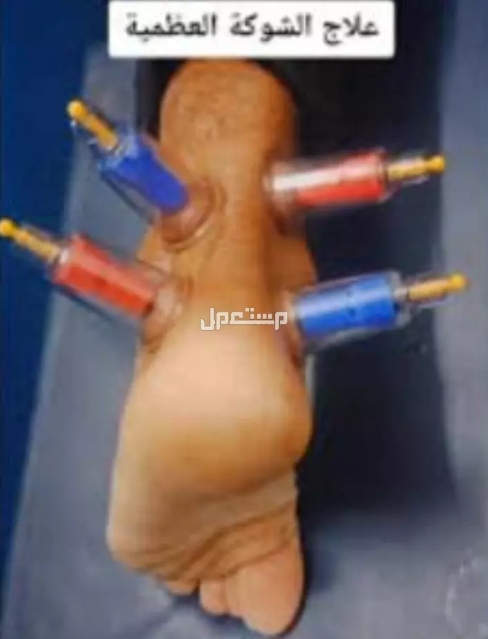 حجامه علاجيه و مساج تدليك منزلي حجامة الرجل