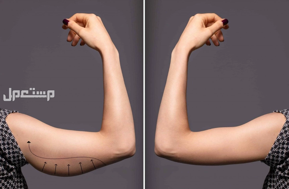 أشهر  10 أنواع عمليات التجميل وأسعارها في 2025 وأسباب إجراءها عملية شفط الدهون قبل وبعد