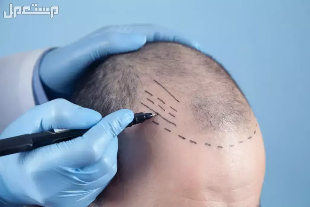 أشهر  10 أنواع عمليات التجميل وأسعارها في 2025 وأسباب إجراءها عملية زراعة الشعر بالتقنيات الحديثة