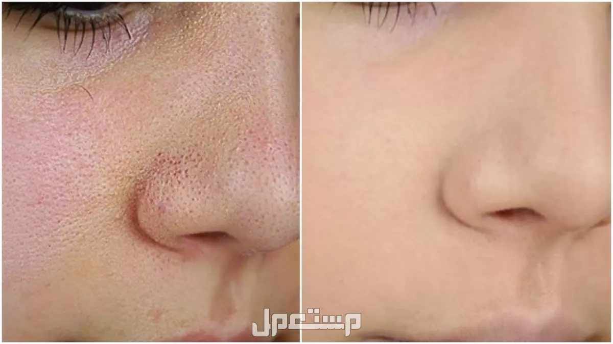 كيفية الحصول على بشرة صافية بدون مسامات بالخطوات كيفية الحصول على بشرة صافية بدون مسامات
