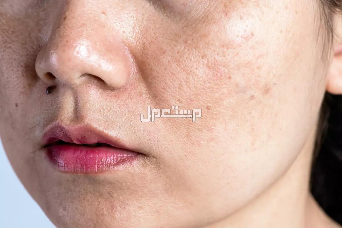 كيفية الحصول على بشرة صافية بدون مسامات بالخطوات ماسك البابايا مع بياض البيض