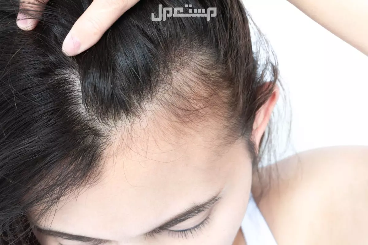 تفسير حلم تساقط الشعر عند لمسه للرجل والمرأة تفسير حلم تساقط الشعر عند لمسه والبكاء عليه للعزباء