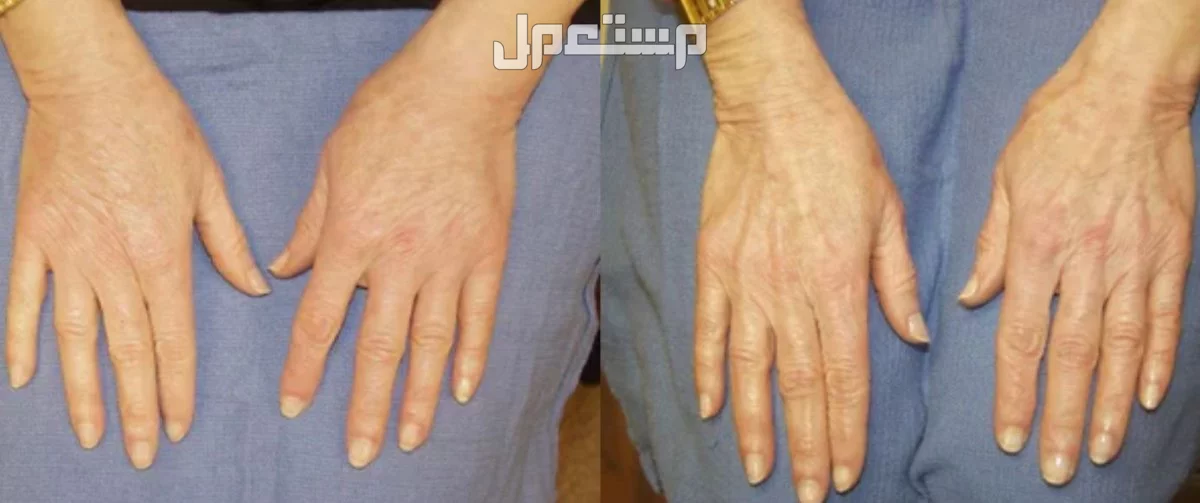 أفضل كريم لشد تجاعيد اليدين مع الأسعار.. 6 خيارات متنوعة كريمات ليدين مشدودة