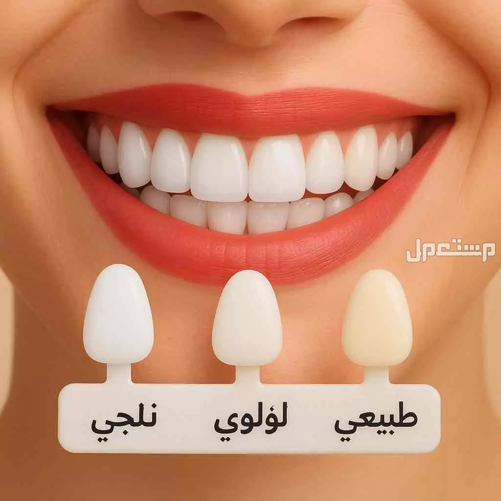 ✨ ابتسامة هوليود المتحركة ✨ (Snap-On Smile) في الرياض