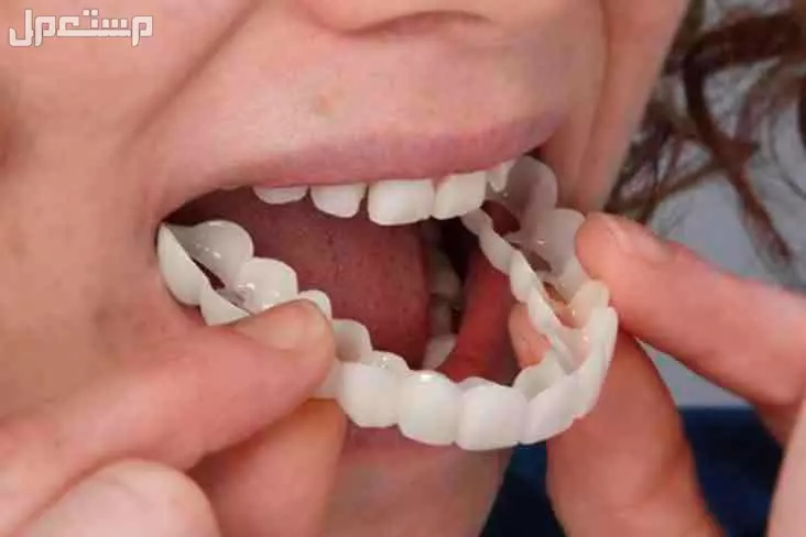 ✨ ابتسامة هوليود المتحركة ✨ (Snap-On Smile) في الرياض