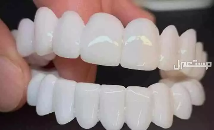 ✨ ابتسامة هوليود المتحركة ✨ (Snap-On Smile) في الرياض