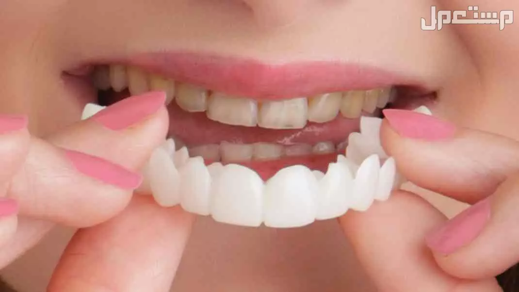 ✨ ابتسامة هوليود المتحركة ✨ (Snap-On Smile) في الرياض