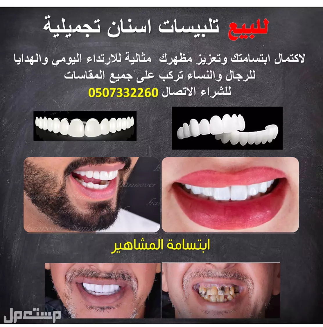 للبيـع تلبيسات اسنان تجميلية  لاكتمال ابتسامتك وتعزيز مظهرك