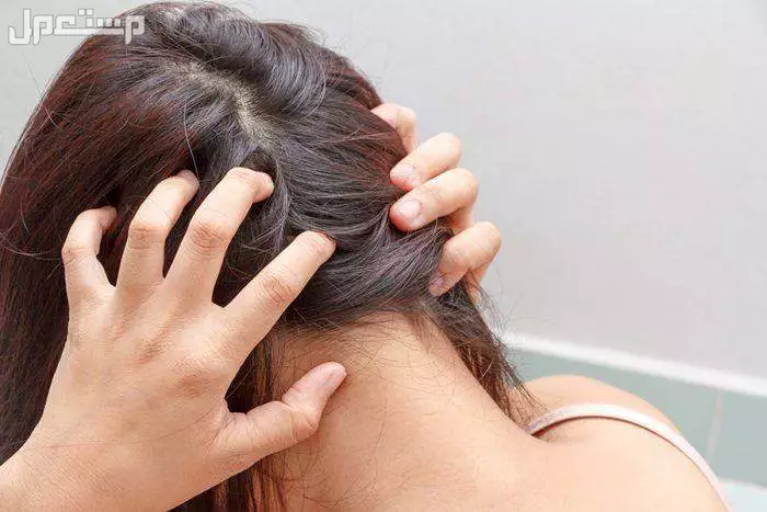 ما تفسير القمل الكثير في الشعر للمتزوجة والعزباء بالتفصيل؟ تفسير القمل الكثير في الشعر للعزباء